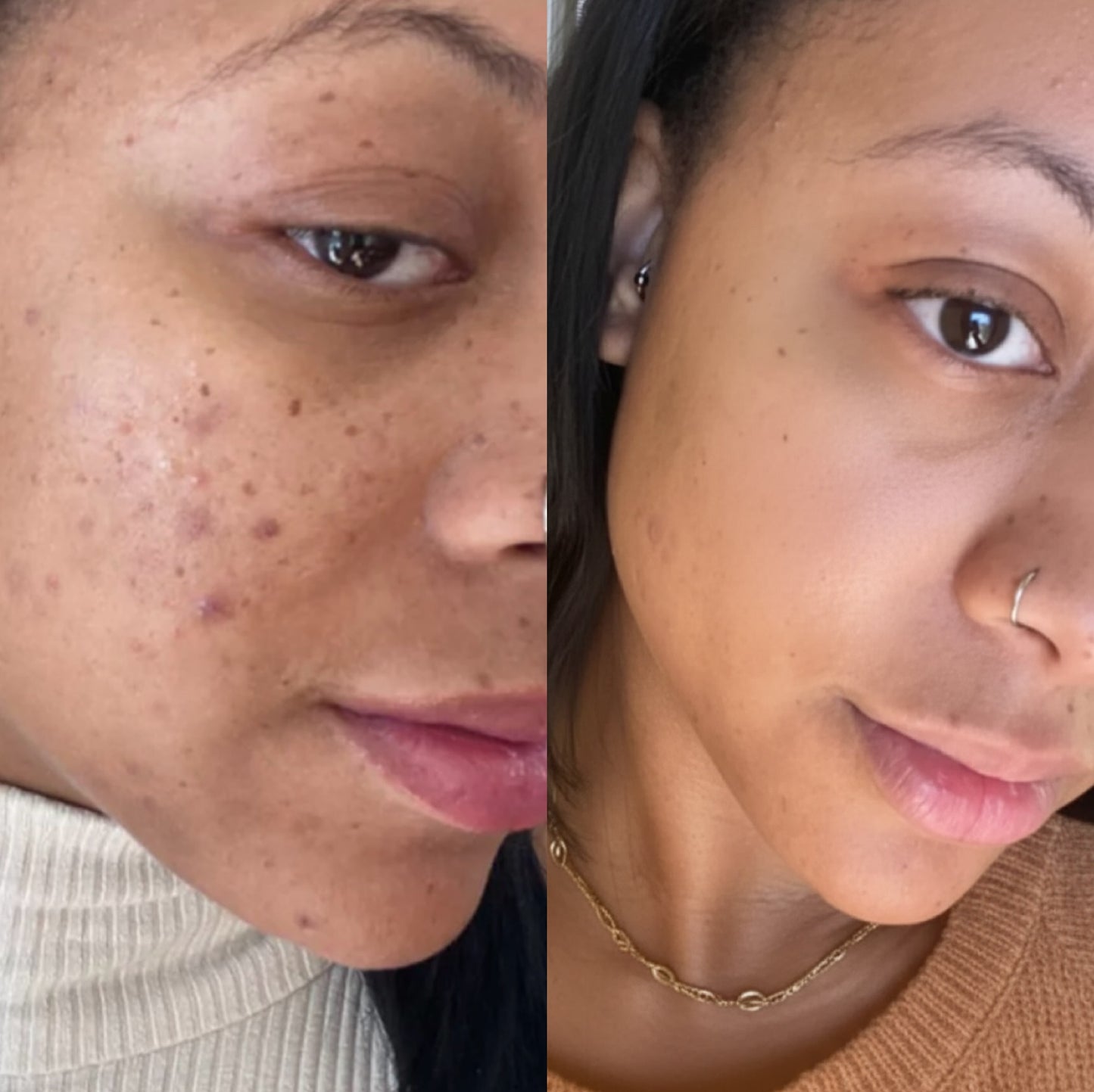 ACNE CONTROL KIT