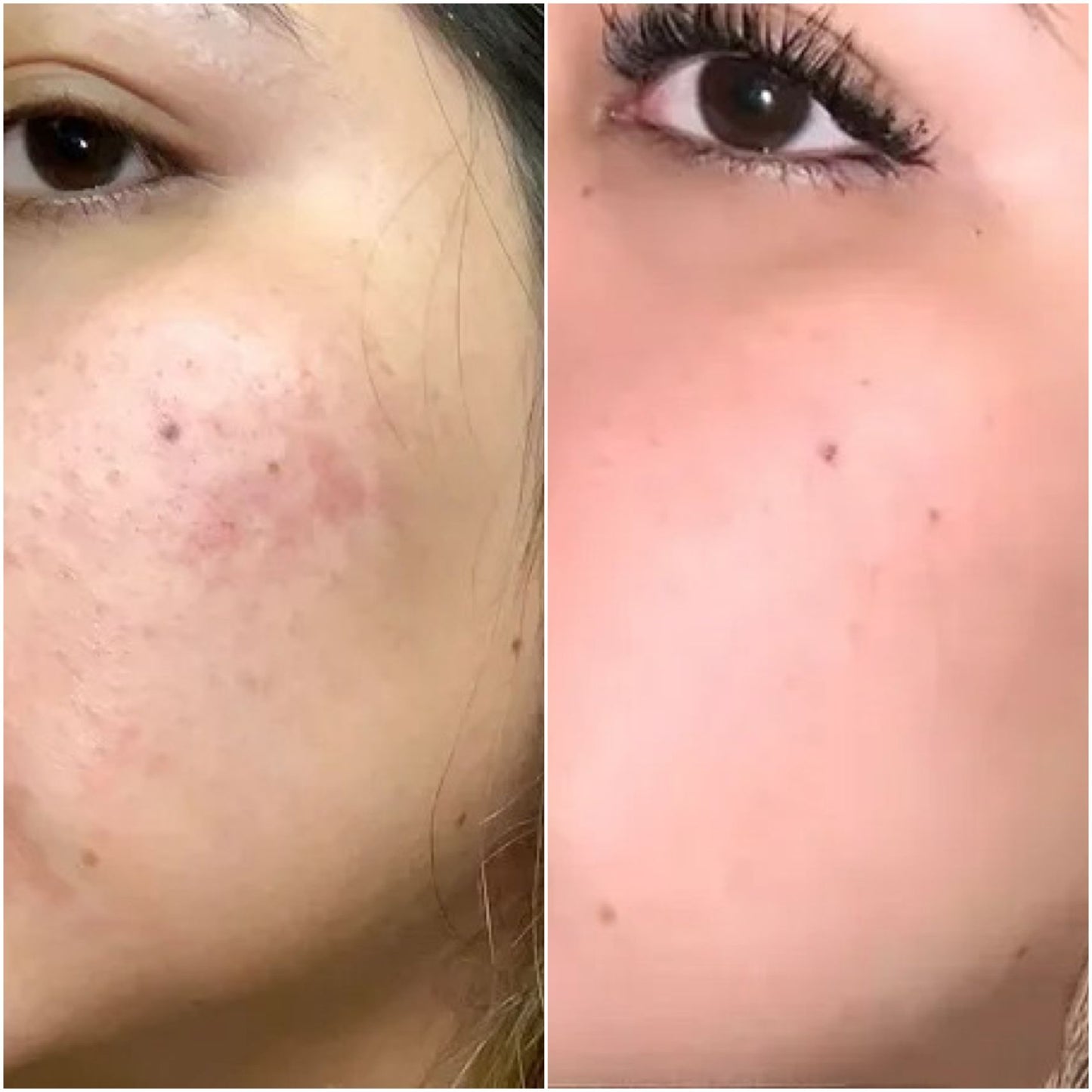 Anua - Azelaic Acid 10 Hyaluron Redness Soothing Serum