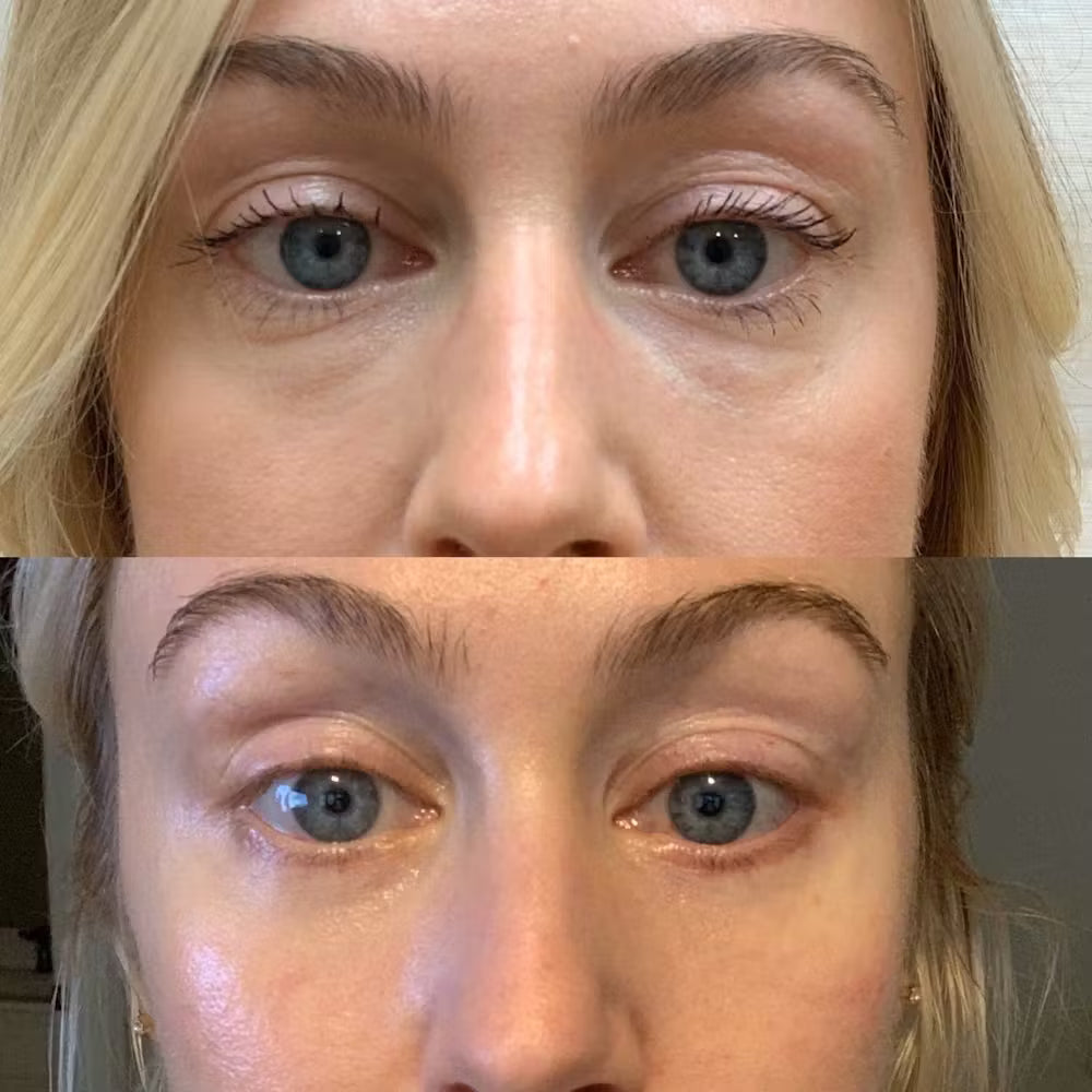 VT - PDRN Reedle Shot Eye Lifter