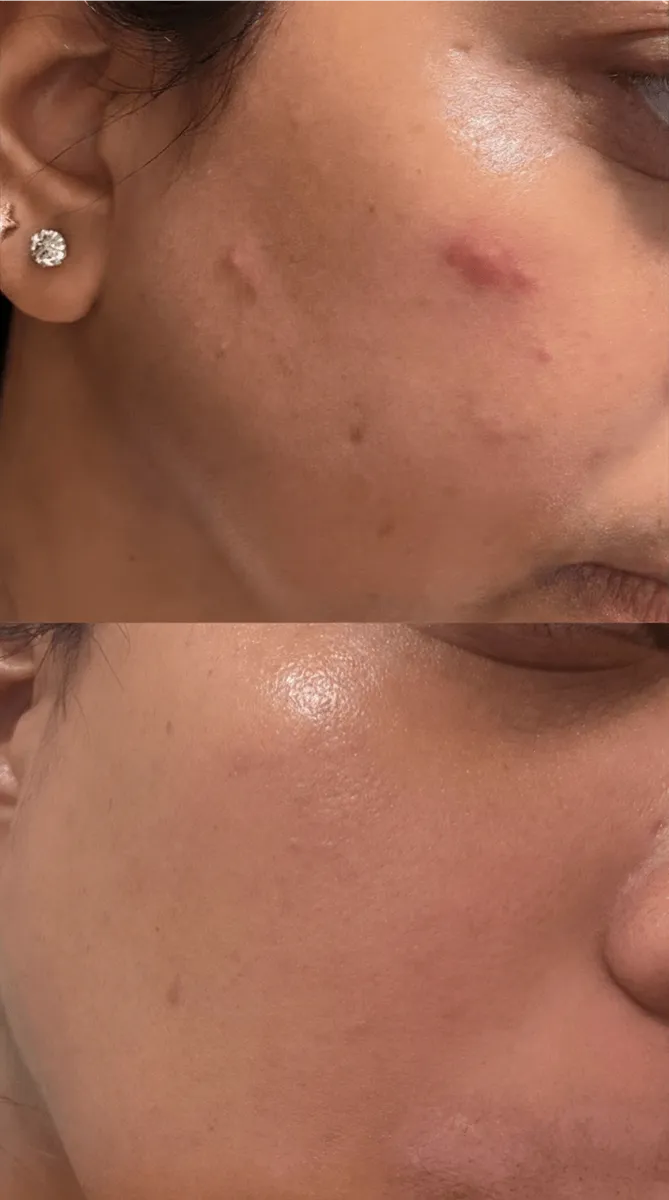 Anua - Azelaic Acid 10 Hyaluron Redness Soothing Serum